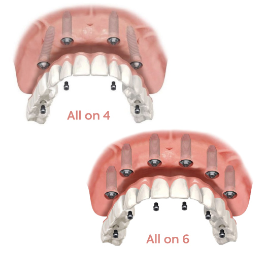 Demonstration of All on 4 vs All on 6 Dental Implants