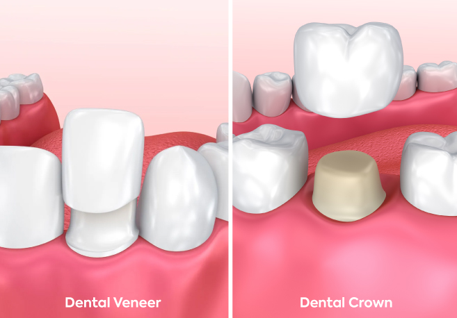 The Differences betweem Dental Crowns and Dental Veneers