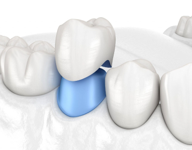 Dental Crowns