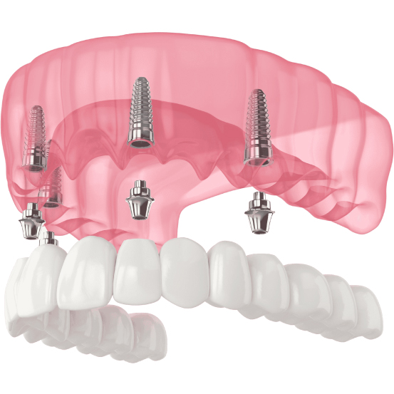 Demonstration of All on 4 Dental Implants