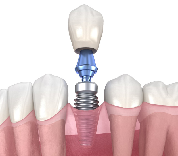 Demonstration of a single dental implant