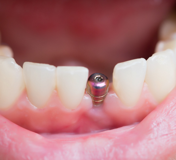 Single Dental Implant Photo