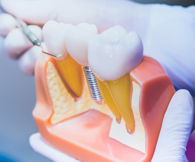 Dentist holding a dental implant model