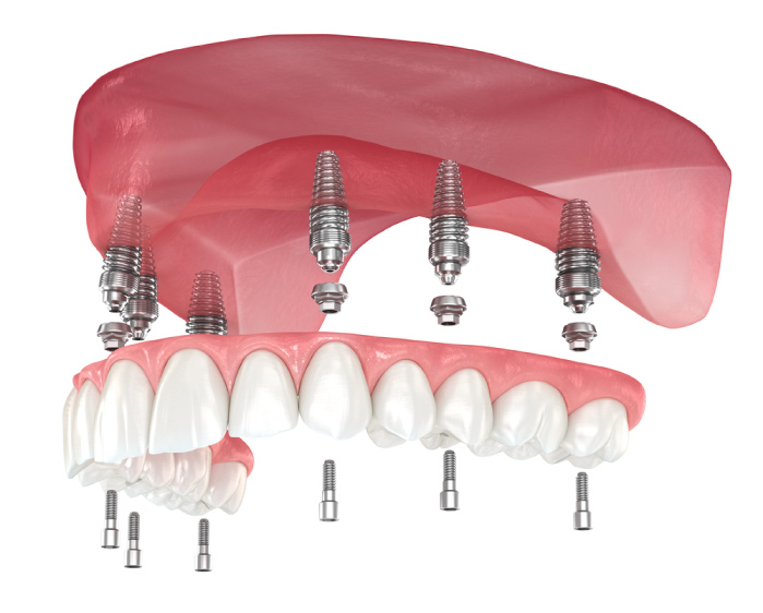 Demonstration of All on 6 Dental Implants