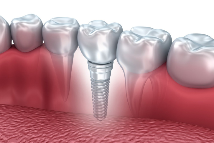 Demonstration of a Single Dental Implant