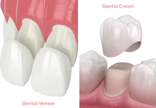 Diffrences between Dental Crowns and Veneers