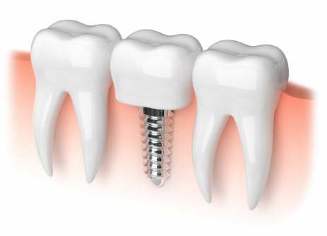 Same-day Immediate Dental Implants