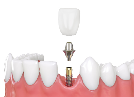 Single Tooth Implant