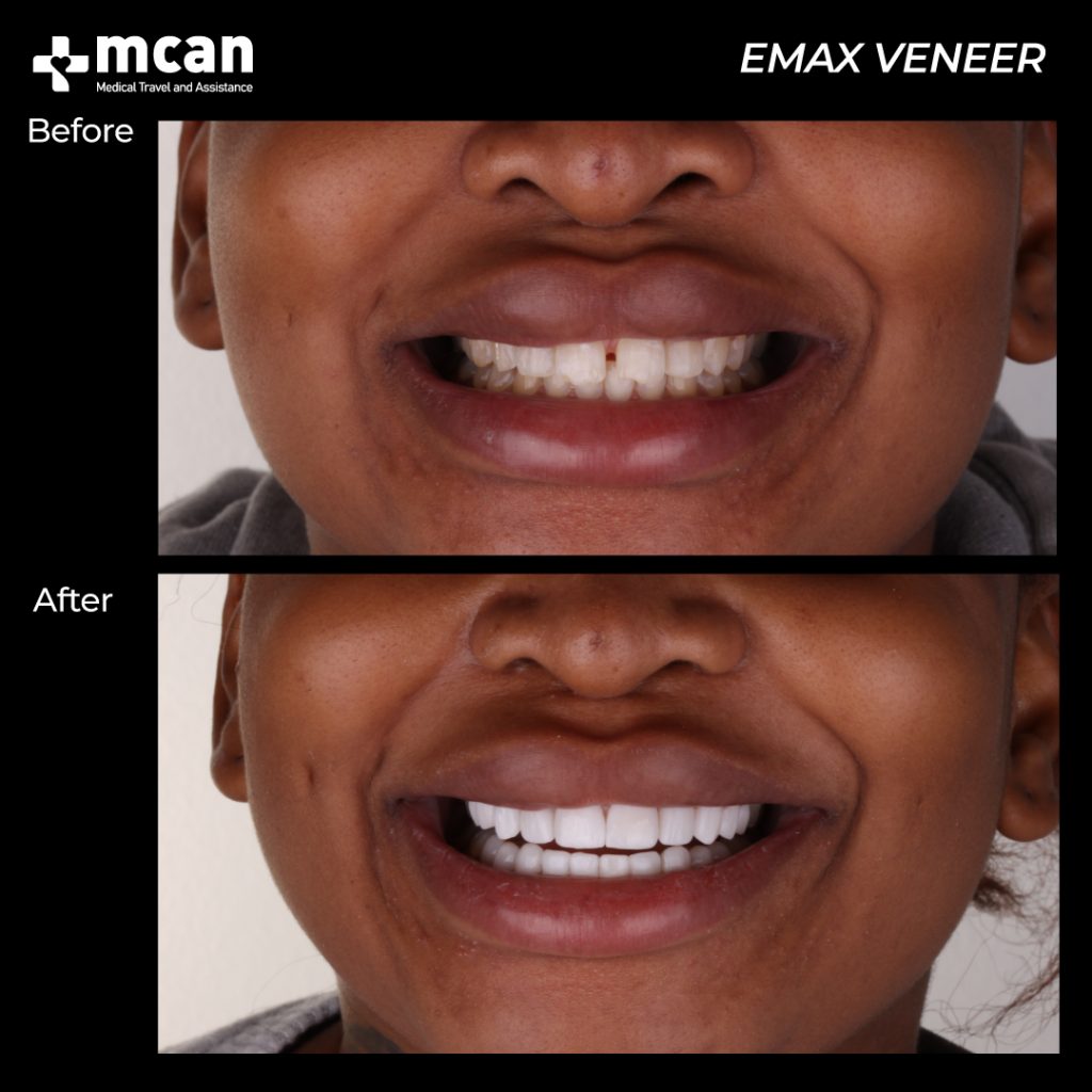 mcan dental emax veneers patient before and after 