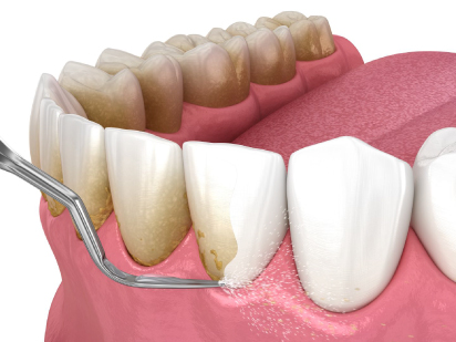 Dental Scaling