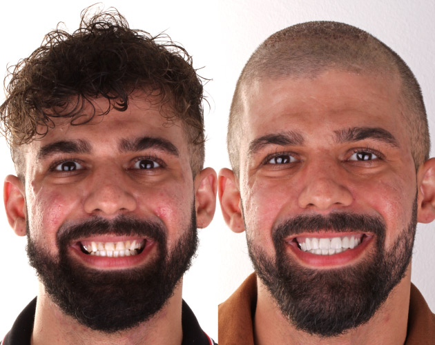 Dental Crowns Placement Before After