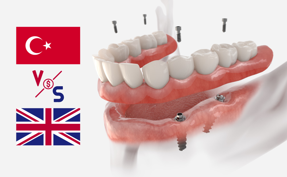 full set of teeth implants cost turkey vs uk comparison blog