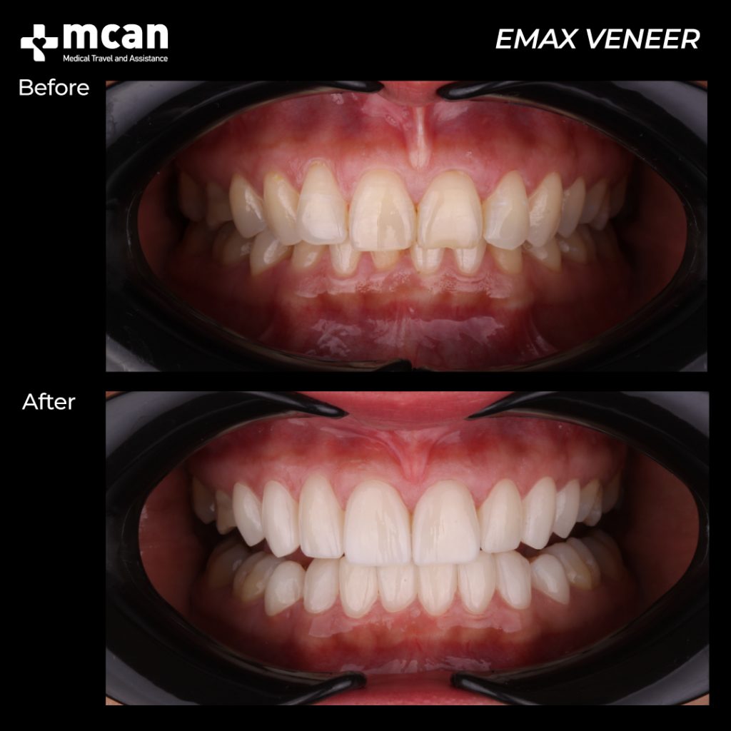 mcan dental before after