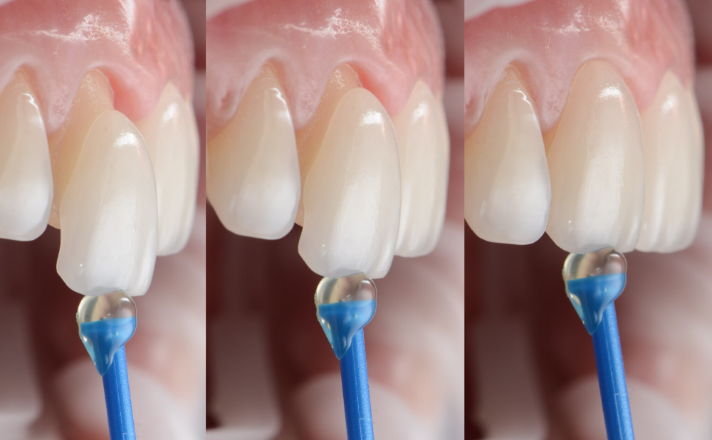 information on emax veneers