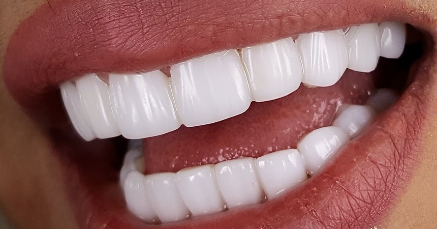 photo of a person with emax veneers 