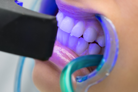 A Photo from a Teeth Whitening Procedure