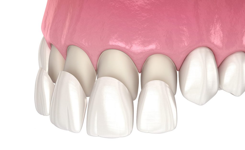 photo of emax ceramic veneers 