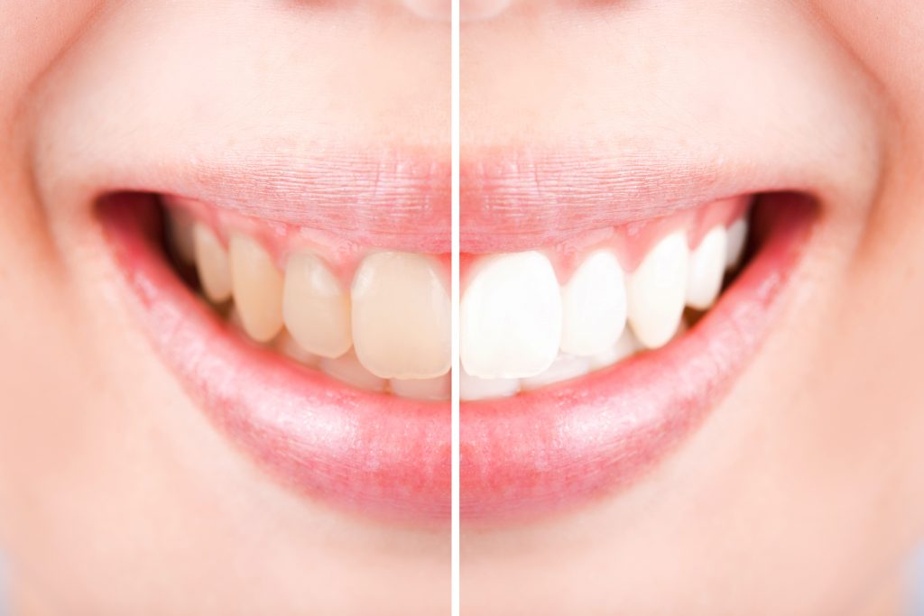 emax veneers in turkey 