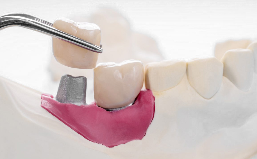 a blog about zirconium crowns