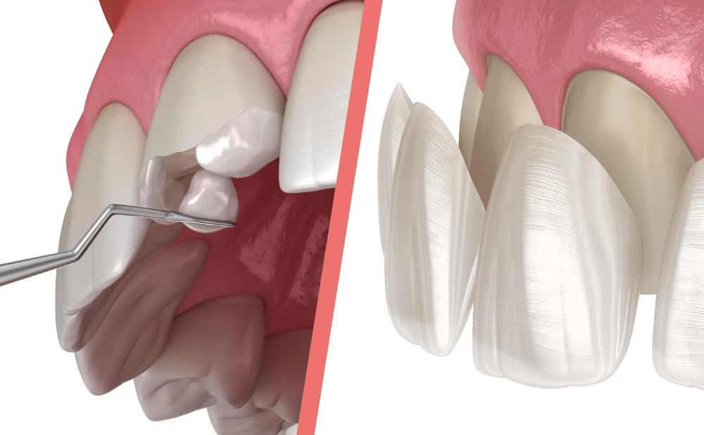 a blog about teeth bonding vs veneers