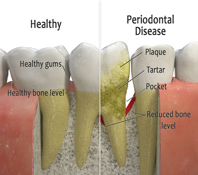 bone loss after dental implant 