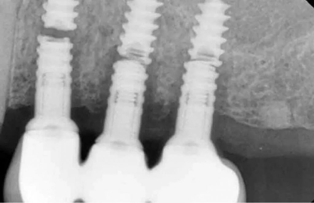 dental implant fractures 