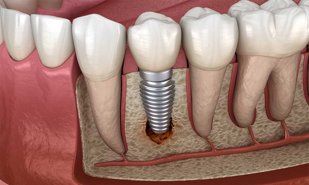 dental implant failure 