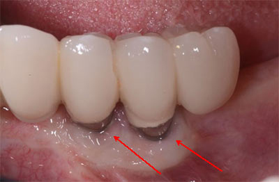 dental implant infection signs 