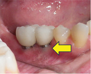 dental implant infection pictures 