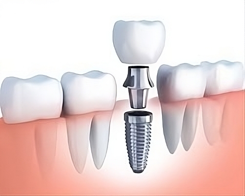 dental implant structure 