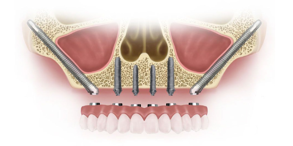 Zygomatic implants graphic.