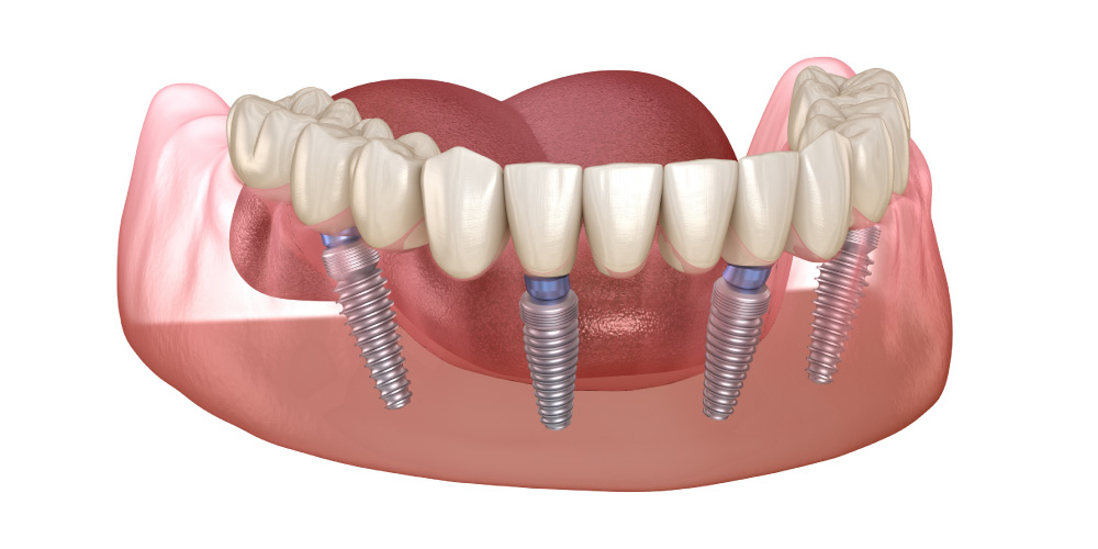 All-on-4 dental implant graphic.