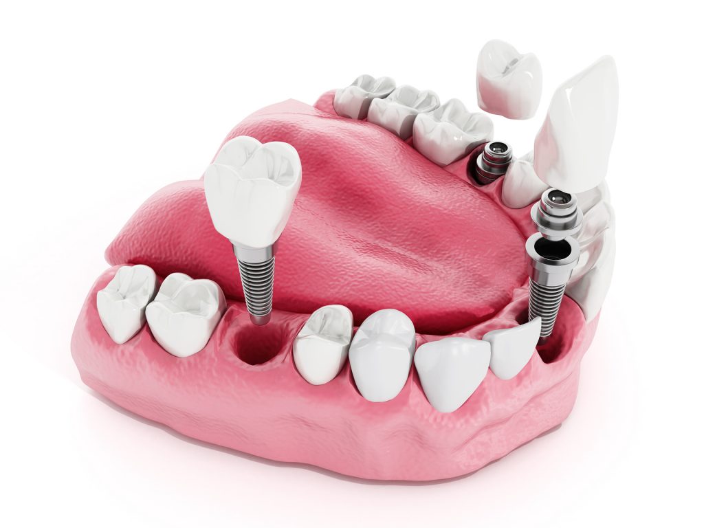 A detail image depicting dental implants.