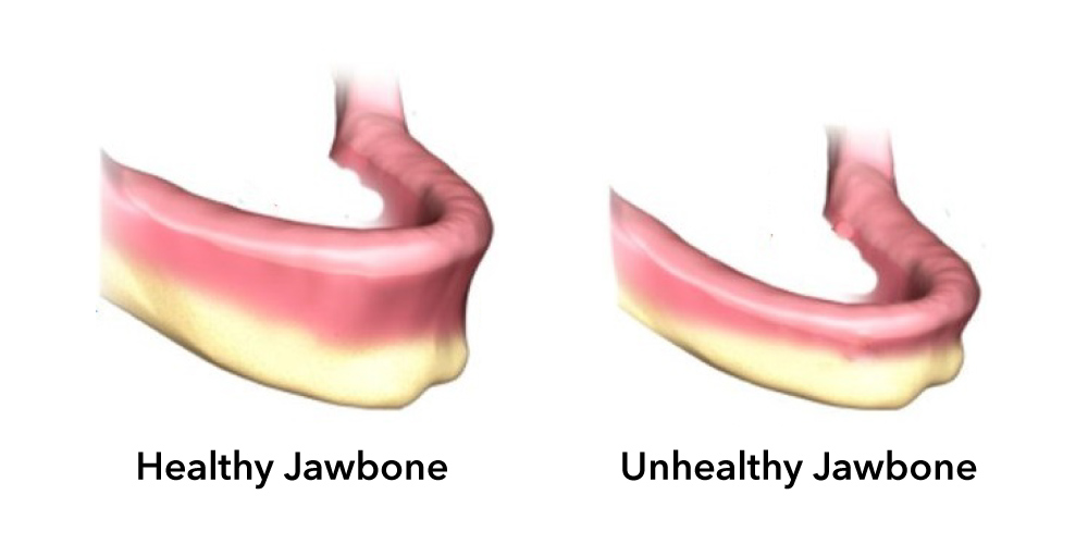 Comparison between a healthy jawbone and an unhealthy jawbone.