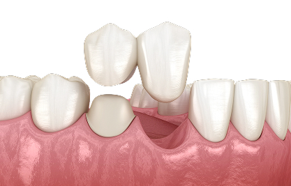 Cantilever Bridge - MCAN Dental