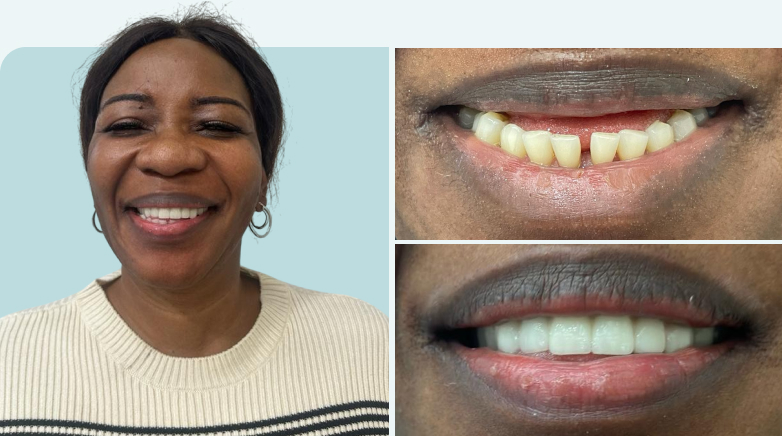 Composite Bonding Before After 2 - MCAN Dental