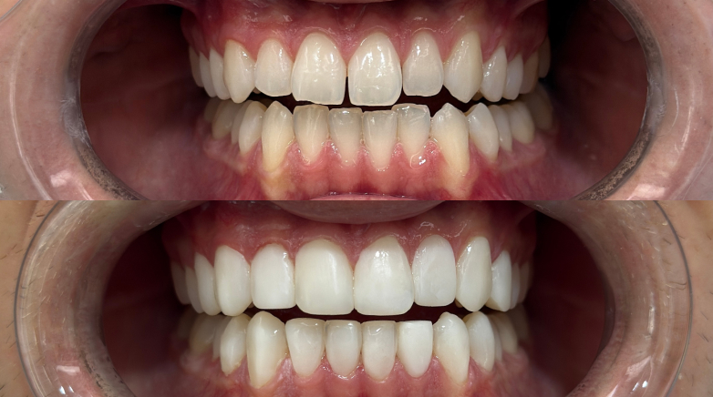 Composite Bonding Before After 4 - MCAN Dental