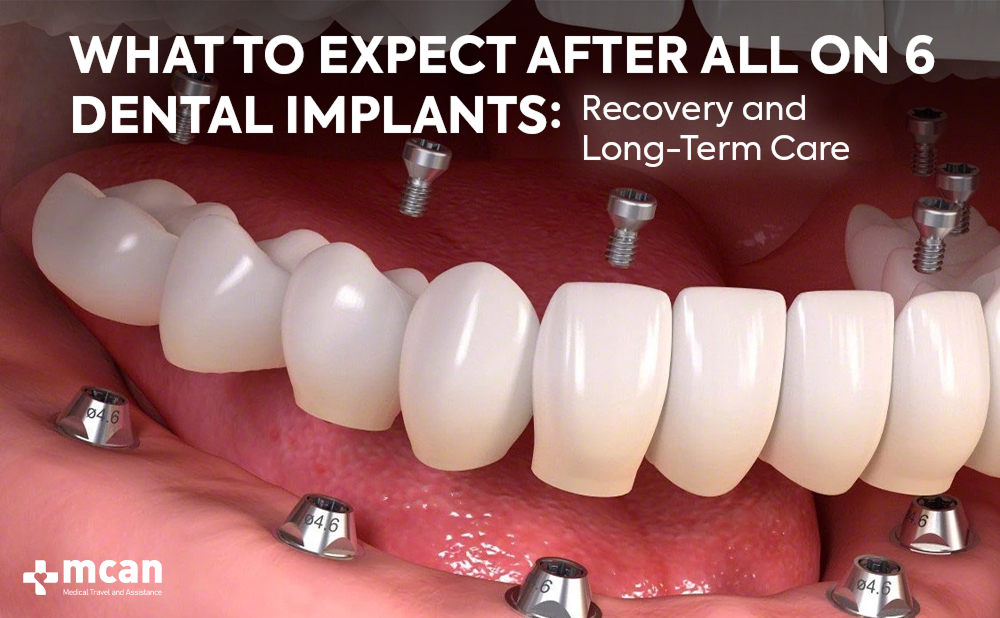 Cover What to Expect After All on 6 Dental Implants - MCAN Dental