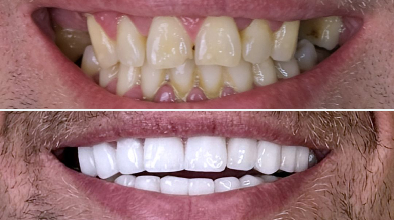 Dental Bridge Results Before After1 - MCAN Dental