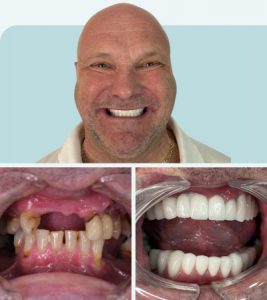 Dental Bridge Results Before After3 - MCAN Dental