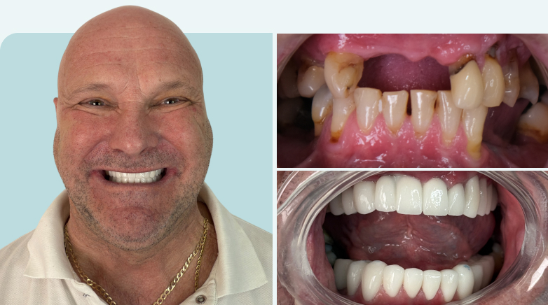 Dental Bridge Results Before After4 - MCAN Dental