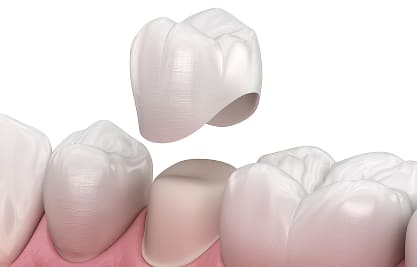 Dental Crowns - MCAN Dental