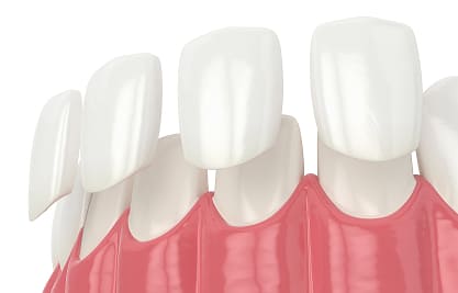 Dental Veneers - MCAN Dental