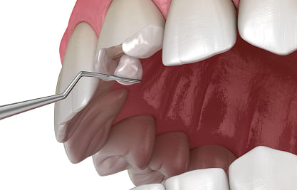 Direct Composite Bonding - MCAN Dental