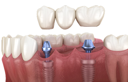 Implant Supported Bridge - MCAN Dental