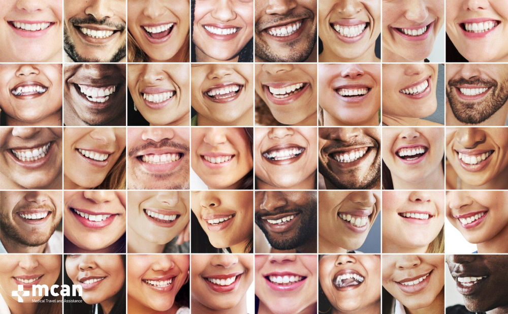 Hollywood Smile in Turkey: What’s Included and Is It Right for You? 2 Is Hollywood Smile Right for You - MCAN Dental
