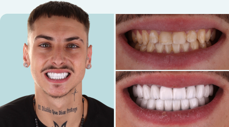 Laminate Veneers Results Before After 1 - MCAN Dental