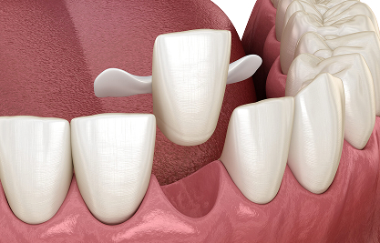 Maryland Bridge Resin Bonded Bridge - MCAN Dental