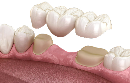 Traditional Dental Bridge.jpg - MCAN Dental