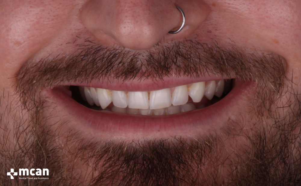 Zirconia vs. Emax Crowns: Which One Offers the Best Aesthetics? 3 What Are Emax Crowns - MCAN Dental